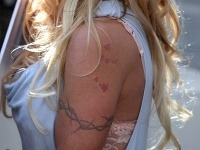 Pamela Anderson má na ľavom ramene škaredé jazvy.