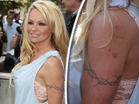 Pamela Anderson má na ľavom ramene škaredé jazvy.
