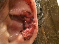 Kožné štepy dievčaťu zachránili ucho