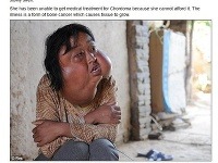 Desivá choroba: Číňanke sa