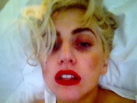 Lady Gaga má po desivom úraze otras mozgu a na tvári monokle.