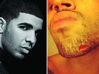 Drake a rana, ktorú utŕžil Chris Brown v bare.