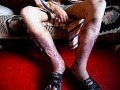 Ďalší hrôzostrašný prípad užívania krokodíla: Tínedžerke zhnili genitálie!
