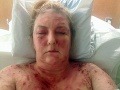 Tri roky hľadala odpoveď na svoj zdravotný stav: FOTO strašného ochorenia, ktoré ju znetvorilo