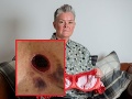 Žena (51) nosila dlhé roky tesnú podprsenku s kosticami: FOTO katastrofických následkov