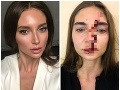 Valentina chcela plnšie pery, skončila so zlomeným nosom: VIDEO Doktorka ma zbila! Hovorí kráska