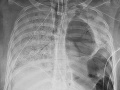 Chirurgovia vykonali unikátnu transplantáciu Chirurgovia vykonali unikátnu transplantáciu