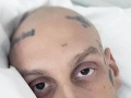 Po prekonaní rakoviny ďalšia Po prekonaní rakoviny ďalšia
