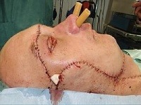 Transplantácia tváre