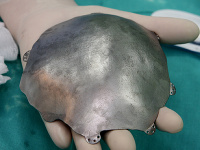 V Košiciach vložili prvému pacientovi unikátny implantát, vyvinutý na Slovensku. V hlave má 400 gramový plát titanu.