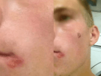 Nezistený druh infekcie