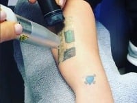 Kelly Osbourne si nechala odstrániť tetovanie