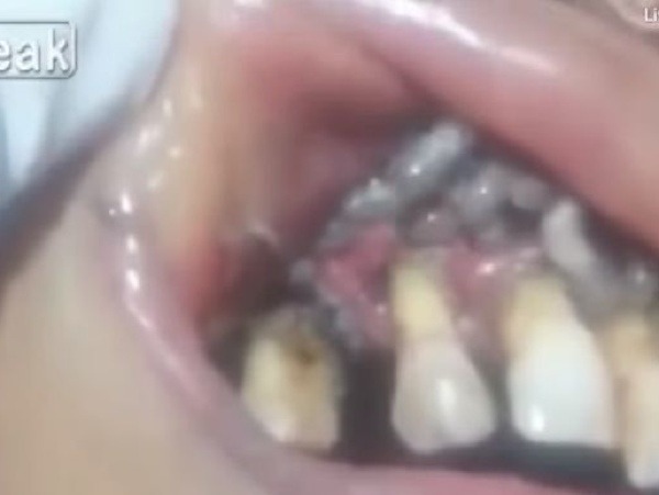 Nechutný pohľad do úst pacientky