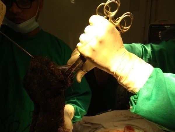 Chirurg vyťahuje z brucha chuchvalec