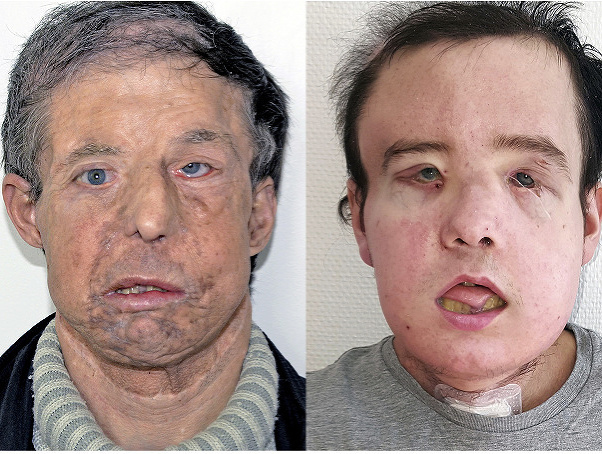Prvá a druhá transplantovaná tvár