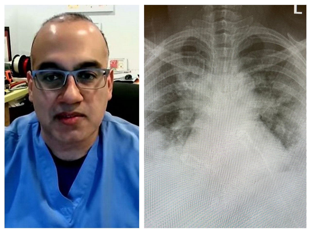 Doktor Kashif Pirzada a snímka poškodených pľúc.