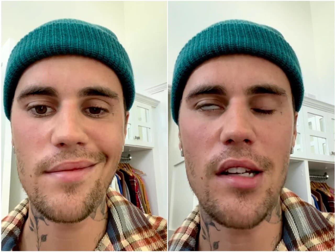Spevákovi Justinovi Bieberovi ochrnula polka tváre. 