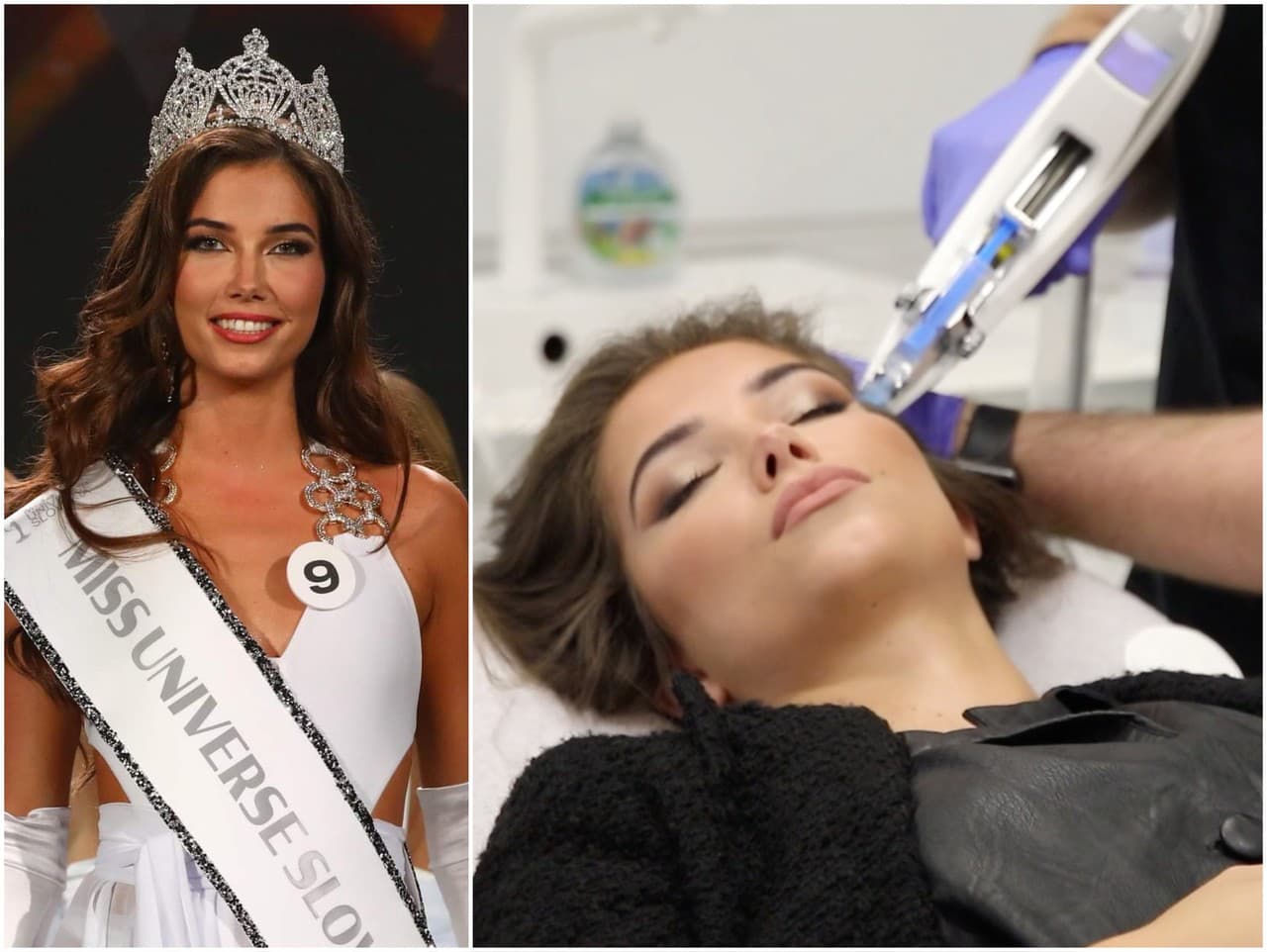 Miss Universe SR 2022 Karolína Michalčíková podstúpila zákrok na klinike krásy. 