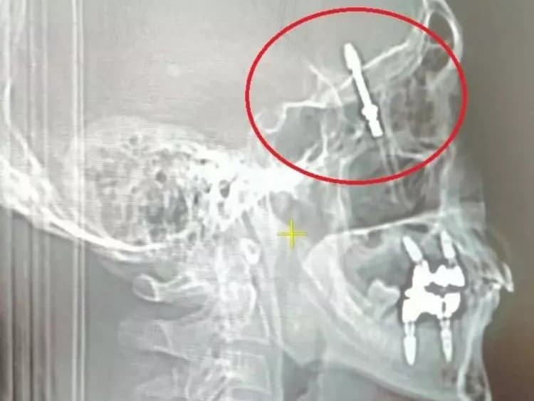 Zubár vrazil skrutku do pacientovho mozgu.