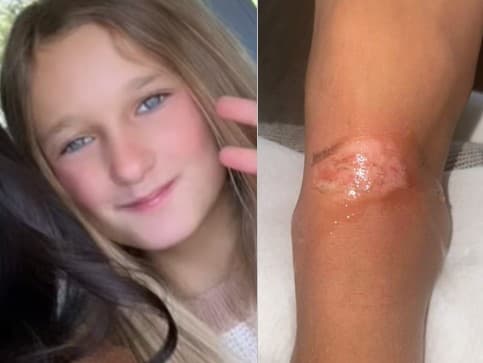 Sienna Klicková (11), ktorej na ponožku vytieklo lepidlo na gélové nechty. Reakcia bola tak silná, že lepidlo sa dostalo priamo na pokožku