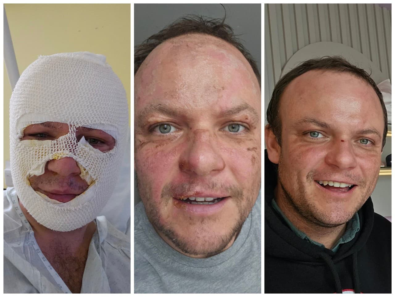 Žiak si popálil tvár pri biokrbe, teraz sa z toho zotavuje.