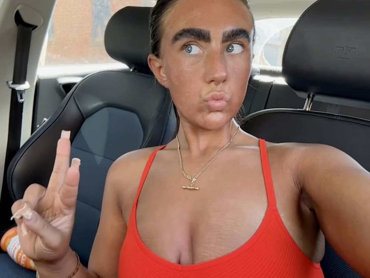 Charlie Urwinovej sa opaľovanie vypomstilo.