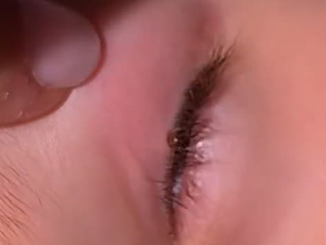 Mama objavila kliešťa u dieťaťa na mimoriadne nezvyčajnom mieste