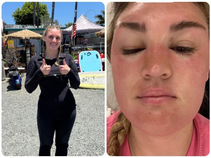 Po dlhšom pobyte na slnku Paige opuchla tvár, prestala vidieť na jedno oko a začala jej odpadávať koža