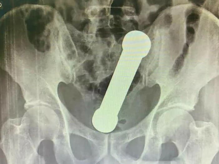 Muž si strčil činku do zadku!