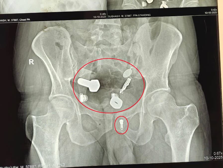 Mužovi našli v útrobách rôzne predmety.