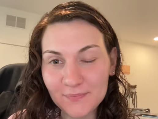 Žene po botoxe ochablo viečko.