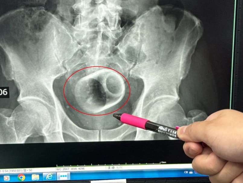 V mužovom konečníku našli keramický hrnček!