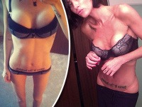 Jasmine Lennard bez hanby vystavuje anorektické telo a spackané prsia po plastike.
