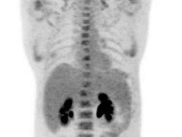 Jediné dve čierne bodky zobrazujú obličky a močový mechúr, nádory zmizli.
