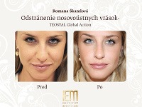 Romana Škamlová pred a po zákroku