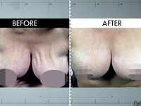 Janice Dickinson si pred kamerami nechala zreparovať svoje 30-ročné prsné implantáty.