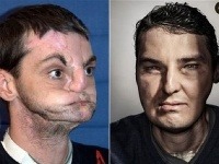 Richard Norris pred transplantáciou a po nej Richard Norris pred transplantáciou a po nej