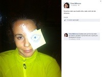 Petra Millerová sa so škaredým zranením pochválila svojim priateľom na sociálnej sieti Facebook. 