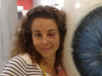 Petra Millerová si pred pár dňami nepríjemne zranila oko - jej tvár teraz zdobí monokel a niekoľko stehov. 