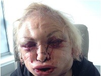 Takto vyzerala Kellie Maloney krátko po operácii, pri ktorej jej išlo o život. 