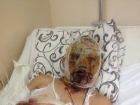 Dorži Batomunkujev leží v nemocnici s ťažkými popáleninami.