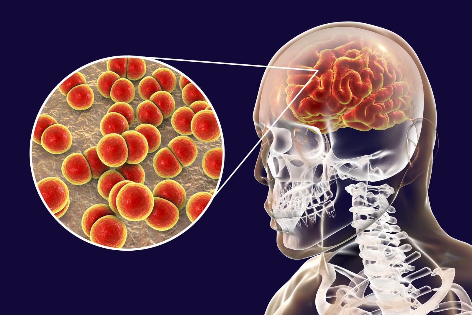 Neisseria meningitidis