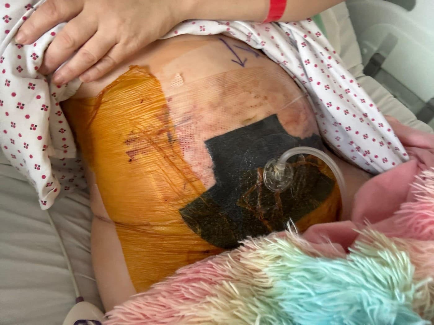 Liposukcia matky troch detí