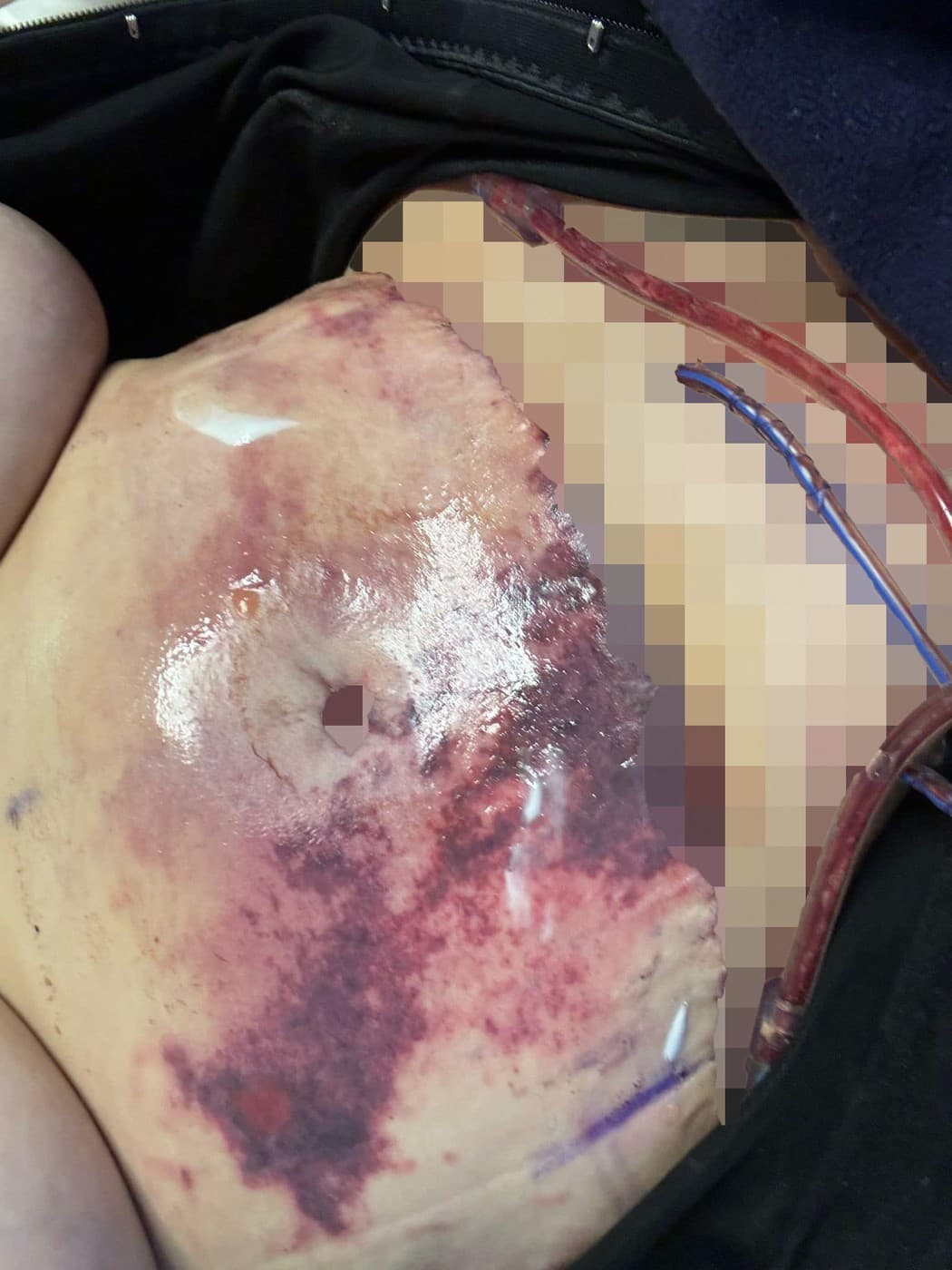 Liposukcia matky troch detí