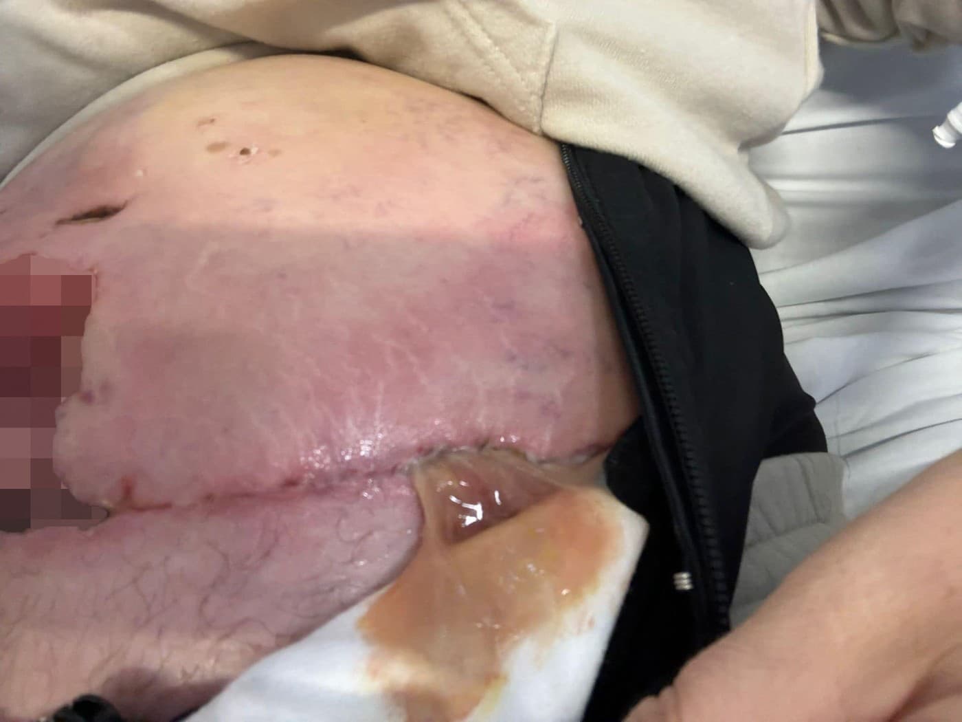 Liposukcia matky troch detí