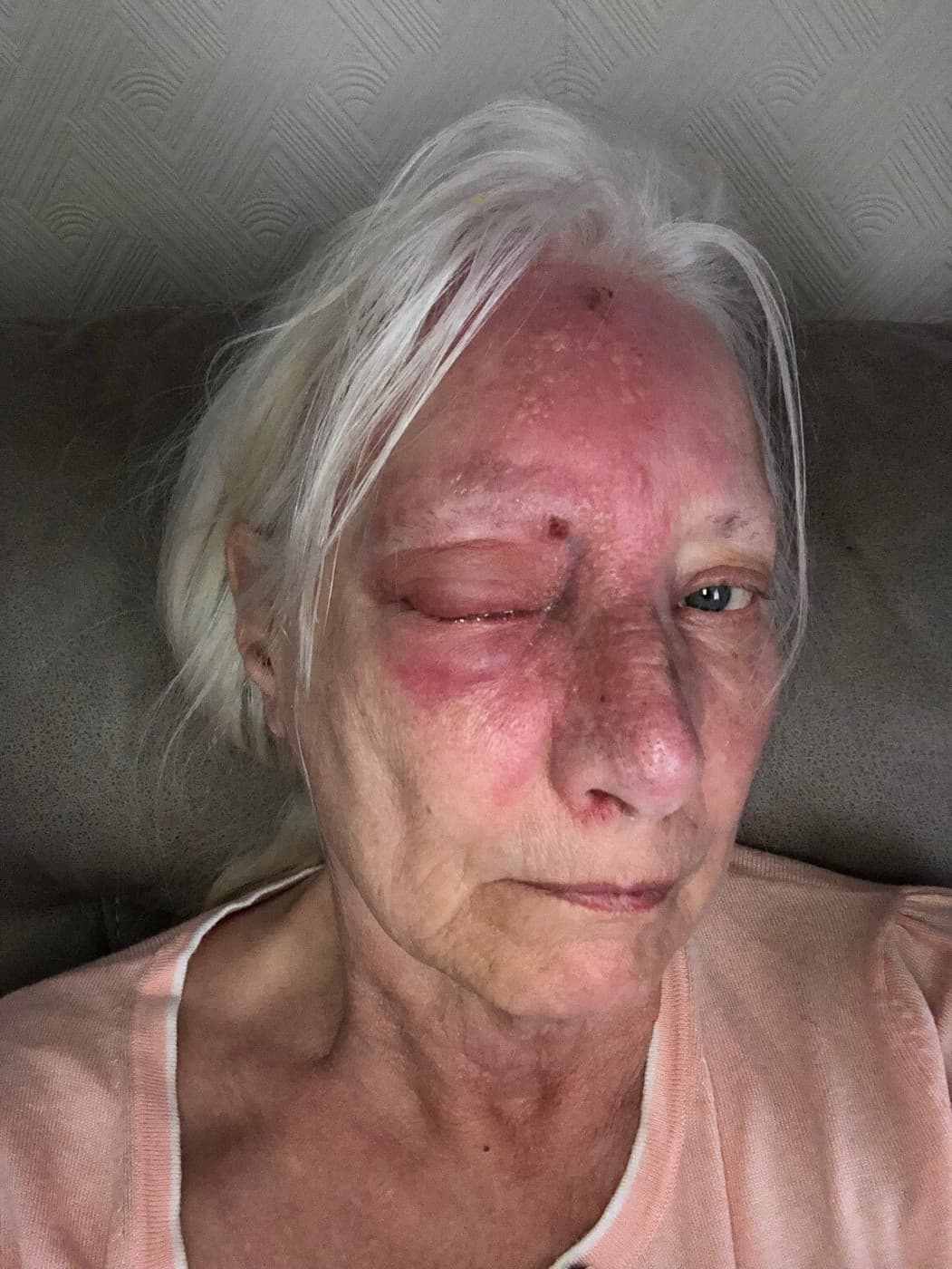 Jean Hill po otrave slnkom