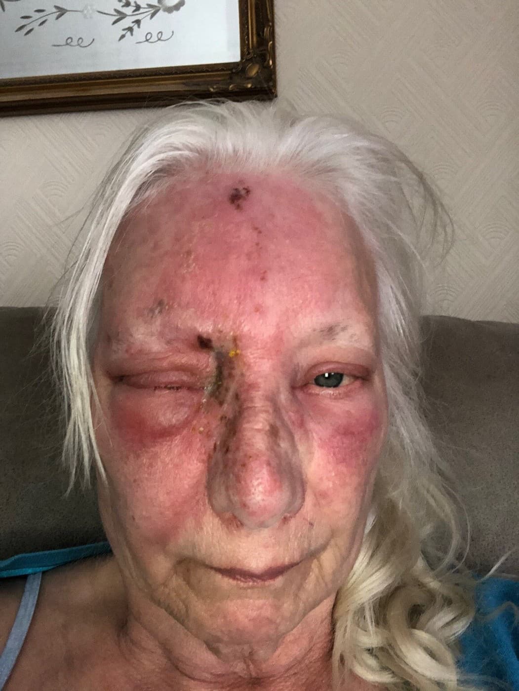 Jean Hill po otrave slnkom