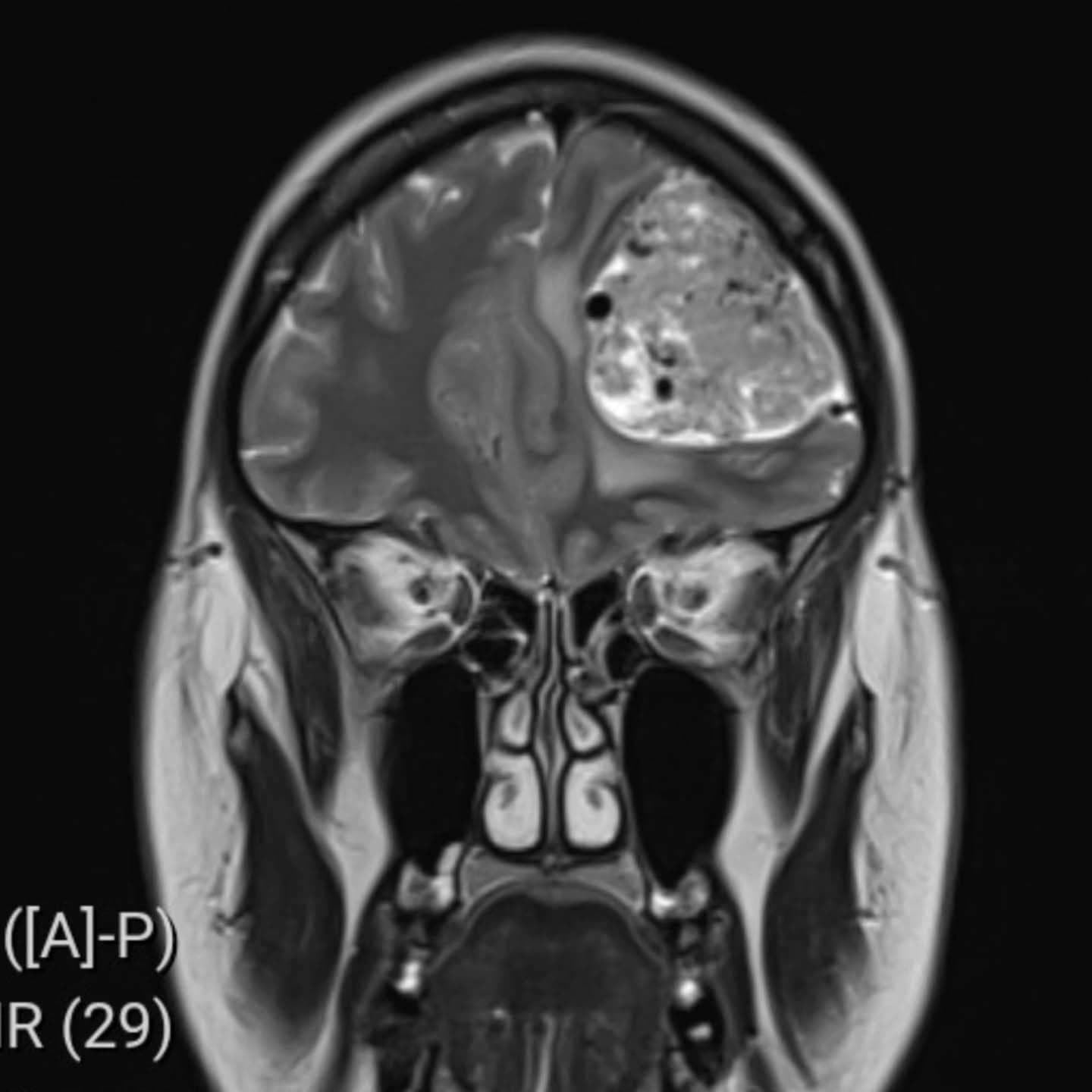 Učiteľka trpela migrénami a