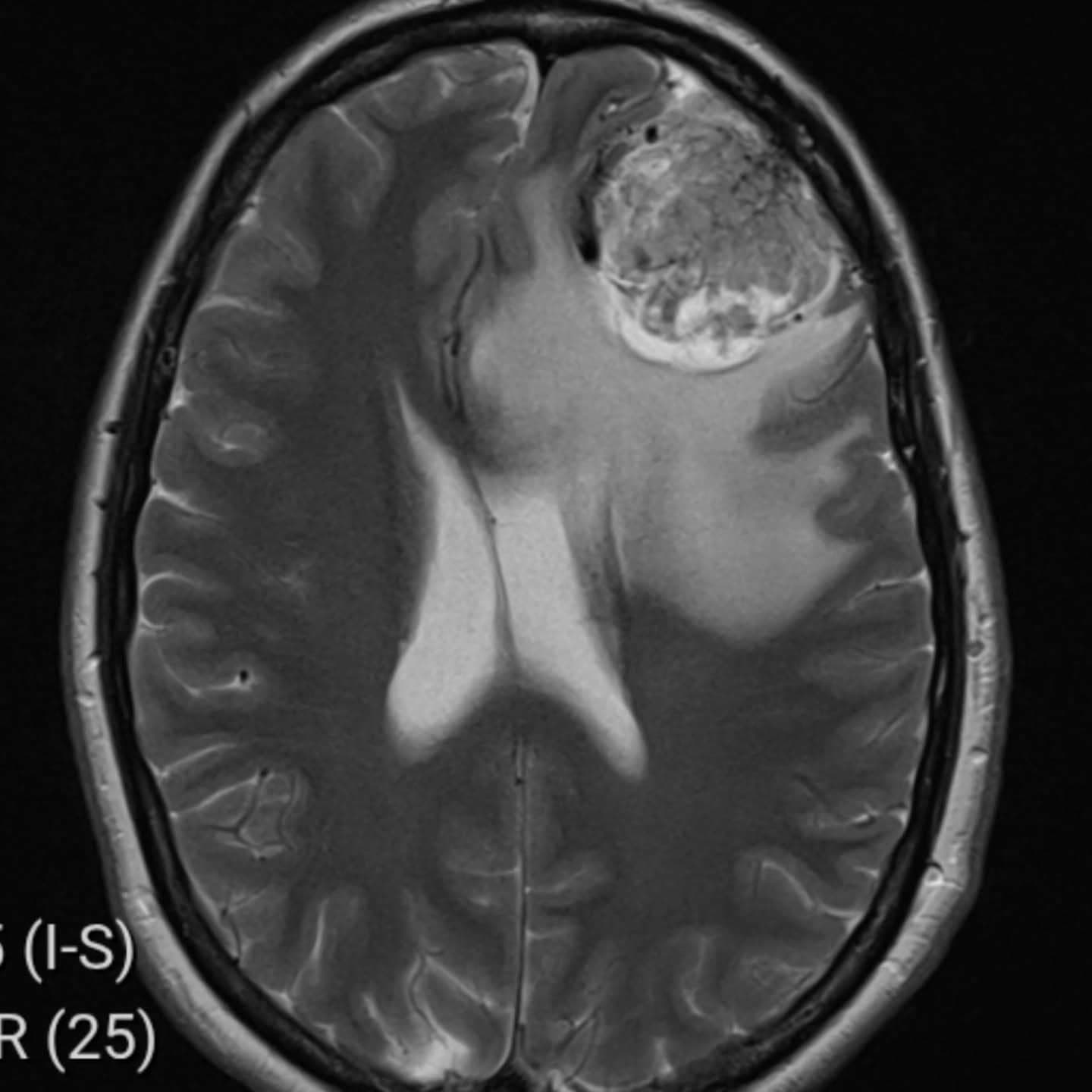 Učiteľka trpela migrénami a