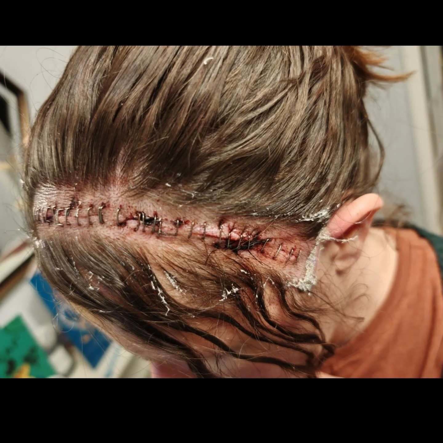 Učiteľka trpela migrénami a